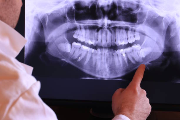 Best Emergency Wisdom Tooth Extraction in Lyndon, KS